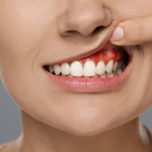 Problemas Dentales Paciente con Diabetes